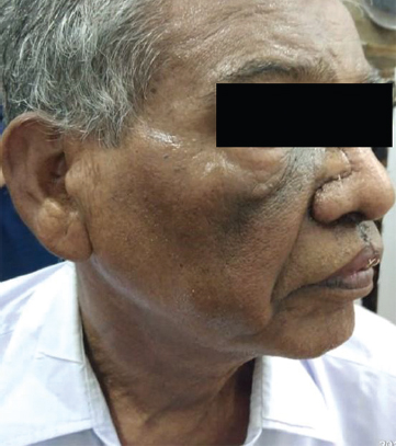 Outcome after one month of surgery with a healed scar.